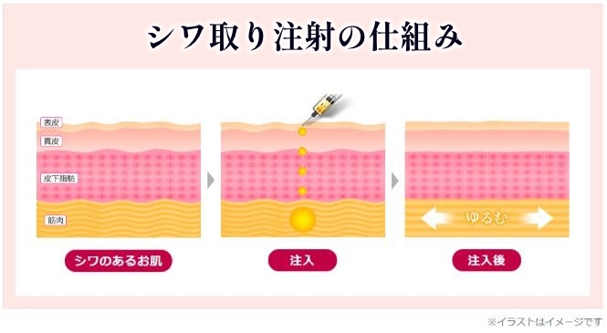 ボツリヌス注入の仕組み【画像】