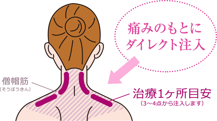痛みのもとにダイレクト注入