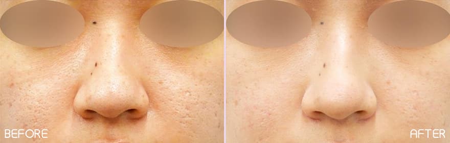 美肌注射の症例写真