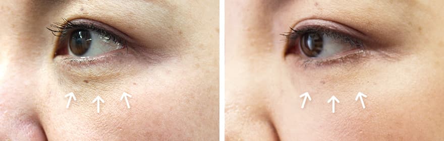 美肌注射 目の下（片目1ccずつ）2回目の症例写真