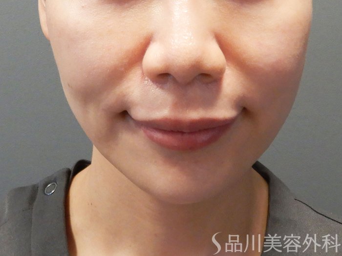 「美肌糸リフト」症例写真 Before