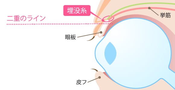 二重術クイック法（埋没法）術 眼球断面図【画像】