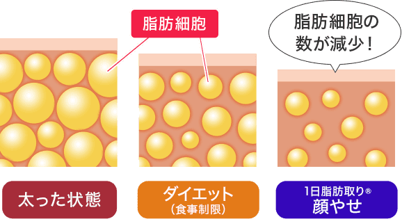 脂肪細胞は太った状態よりもダイエット（食事制限）時のほうが少なく、それよりも1日脂肪取り® 顔やせのほうが少ないです
