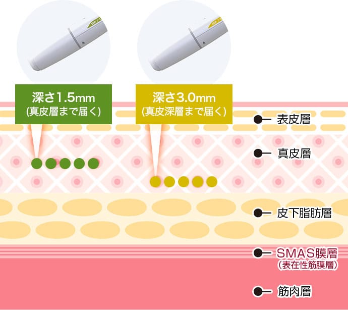 3D HIFUのカートリッジ、1.5mm / 3.0mmのイメージ図