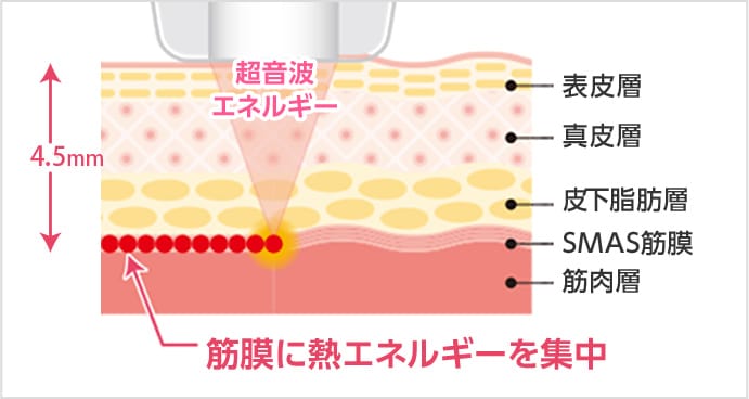 筋膜に熱エネルギーを集中【画像】