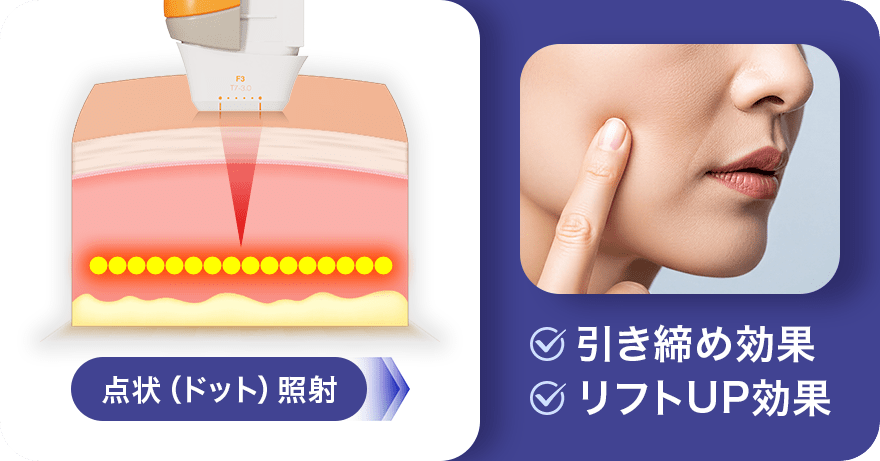 点状（ドット）照射 引き締め効果・リフトUP効果