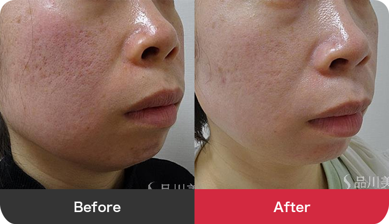 フォトシルクプラス 症例写真【画像】