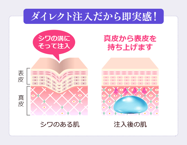 ダイレクト注入だから即実感!シワのある肌、表皮・真皮、シワの溝にそって注入。注入後の肌、真皮から表皮を持ち上げます。